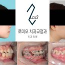 로미오치과교정과치과의원 네이버블로그