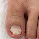 레푸스인하대역점 내성발톱 무좀발톱 발각질 문제성발 이미지