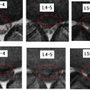 ecto 님의 요추디스크 L3-4, L4-5, L5-S1 의 MRI 판독입니다. 이미지