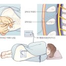 진통 시 마취[Labor analgesia] 이미지