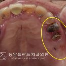 동암튼튼의원 | 치아부러짐 치아가 부러졌을때 어떻게 치료하나요