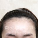 헤어라인 이미지