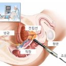 항문초음파 산부인과 이외 더 알 수 있는 것은 (전립선 검사) 이미지