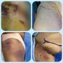 RR-911[석보로]-하-11 | 대퇴천자부위 Sandbag