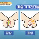 손가락으로 '이 모양' 안 되면 폐암? 초간단 진단법 이미지