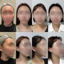 엘레브 | 청담 리프팅맛집 • 엘레브의원에서 통증없이 티타늄...받고 • 당일부터 2주차 • 한달차까지 솔직후기 ⭐️