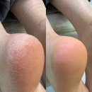 레푸스연신내점 | [연신내] 레푸스 연신내점 은평구 발각질 제거 후기 발뒤꿈치각질제거 불광 홍제 내성발톱 관리