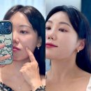 타이트짐 | 울쎄라 써마지 대신 대전 올타이트리프팅 피부과 관리 후기