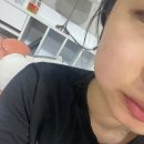 마로니에치과의원 | 대전 둔산동 마로니에 치과 사랑니 발치 | 1~3일차 붓기, 비용, 식사