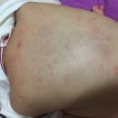 선생님 아기 등에 땀띠 맞나요? [사진첨부] 이미지