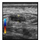 경동맥초음파; Giant cell arteritis (aka. temporal arteritis) 들어보셨나요?? 이미지