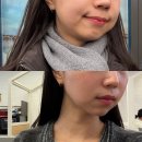 멍제로 | 압구정 온다리프팅 고통 없이 브이라인? 멍 붓기 제로 다운타임 후기
