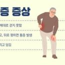 척추 협착증 및 이미지