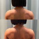 라인스킨 | 광주웨딩관리 승모근 팔뚝 라인 변화, 365메디스킨 광주본점 솔직후기