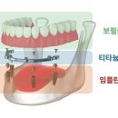 60대 필수 치과 정보: 틀니와 임플란트, 무엇이 나에게 더 좋을까 이미지