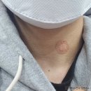 남자 갑상선 결절 초음파 / 세침 검사 [민병원] 후기