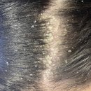 비듬(Dandruff) 이미지
