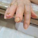 용인니티아토피건선부스럼내성발톱손톱전문관리샵 | 분당 문제성발톱 손톱 복원관리 손상 복구 결과 깔끔했어요!