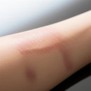 세움메디칼 | 문신제거 비용, 제대로 알고 선택하기