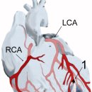 심근경색증[myocardial infarction] 이미지