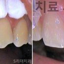 에스치과기공소 네이버블로그