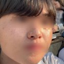 심한의원 | [압구정 반딧불의원 후기] 컴플렉스가 심한 나.. 드디어 피부과에서 주근깨 색소 레이저 받다