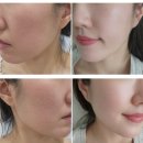 순마음의원 | 강남구청역피부과 솔린의원 PDRN재생주사 물광주사 후기