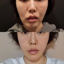 청담동 M한의원 실리프팅 추천 양악시술 중안부 효과 대박