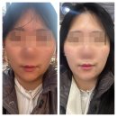 이유치킨 하남미사역점 | 하남 작은얼굴 &#39;가인미가 하남미사역점&#39; 10회차 내돈내산 후기