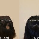 딜리버즈뷰티 | 풍부한 경험과 노하우 울산 탈모 딜리버즈뷰티