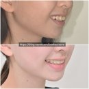 어린이 돌출 인비절라인 퍼스트 악궁확장 유지장치 치료 후기 기록 소아교정