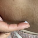 와인피부과의원 | 인천 지방분해주사 출산 후 하복부 찐후기 2회차
