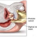 전립선 검사는 필수 이미지