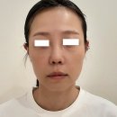 예쁨현의원 | 대전 실리프팅 전문 예쁨현의원 울퉁불퉁 턱필러 실리프팅 윤곽잡기 (feat. 수면 시술)