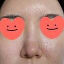 불타는 복권 | [병환일지] 내가 주사 피부염이라니 7 (수란트라 일주일 사용 후기)