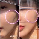 손유나클리닉 얼굴캣 땅콩형얼굴 후기 내돈내산