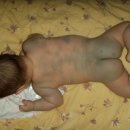 몽고반점 이미지