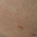 혜강병원 | 미래아이산부인과 난소기형종 복강경 수술 후기(3-4)