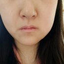 연세바른약국 | 하남 미사 연세바른치과 매복 사랑니 안아프게 잘 빼는 치과 발치 후기