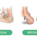 복숭아뼈 통증 원인 골절 부음 물혹 이미지