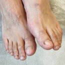 닥터페디 해운대장산점 | 닥터페디 해운대장산점 문제성발톱 관리 후기