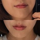 청담에너지 | 청담리프팅 세르프 울써마지 비교 효과 7일 후기
