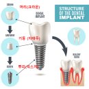㈜선흥무역 | [공지] 미사역임플란트, 39만원 임플란트 정말 괜찮을까요? <의사답변> (비용,가격)