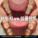 남포동치과 어금니 브릿지 vs 임플란트