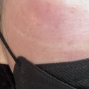 블레스유외과의원 | 볼모공 없애기 ④ 인피니(신논현역 피부과) 리쥬란힐러(대림역 성형외과)