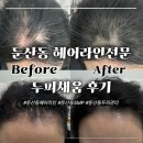계류 및 원형바닥분 | 대전 둔산동 헤어라인 전문 두피채움 앞머리 원형탈모 보완 후기