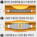 &#39;스텐트 시술 꼭 할 필요 없다&#39; 이미지