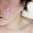 프라임 | 오송 피부관리 제이앤제이에스테틱 케라손프라임 관리후기