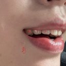 서울미소디자인치과의원 | 아나운서의 자신감, 환한 미소로 완성하다: 강남 미라인치과 라미네이트 후기