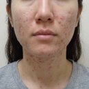 메디인 | (사진후기) 메디인랩 앰플 티트리 A3 재생크림 레이어링